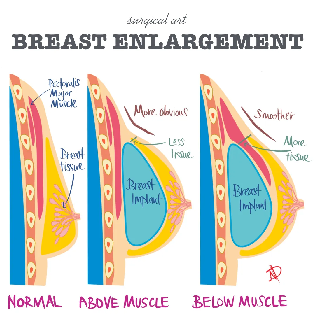 Surgical art illustration of breast enlargement implant placement